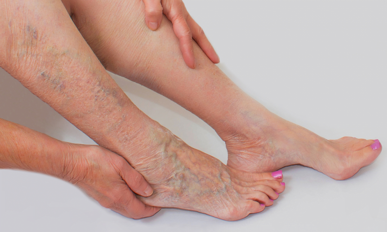 Benefits of Compression Stockings for Varicose Vein