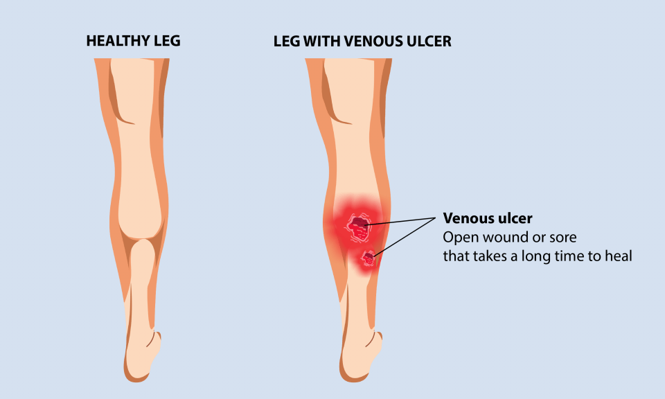 Venous Leg Ulcer Symptoms Causes And Prevention